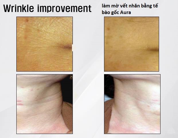 tế bào gốc làm căng da và làm mờ nếp nhăn aura hàn quốc